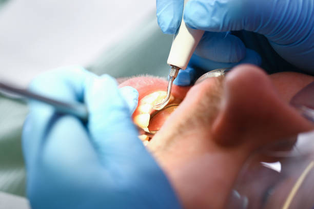 Best Emergency Dentist for Lost Fillings or Crowns in Pen Mar, PA